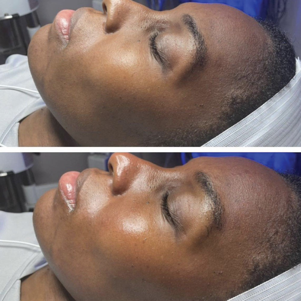 The Benefits of Routine Facials